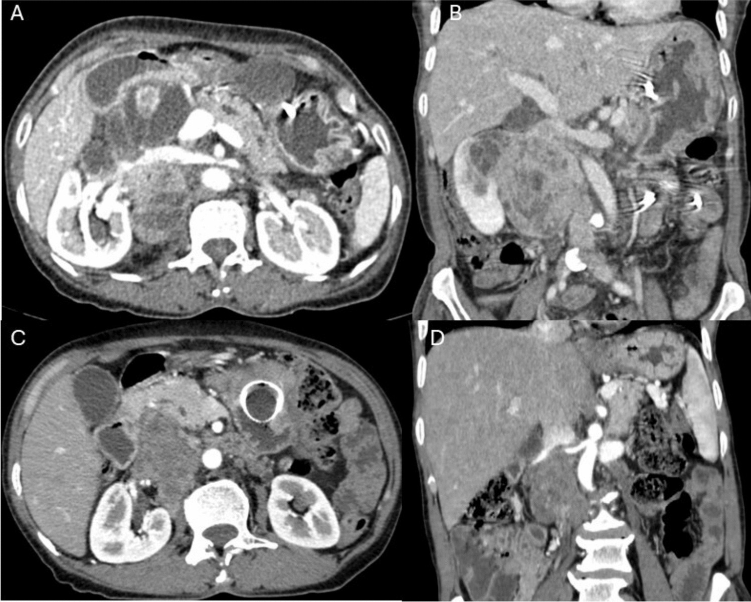 Multivisceral and Vascular Resection for a Locally Advanced Adult Retroperitoneal Rhabdomyosarcoma: Navigating a Clinical Challenge