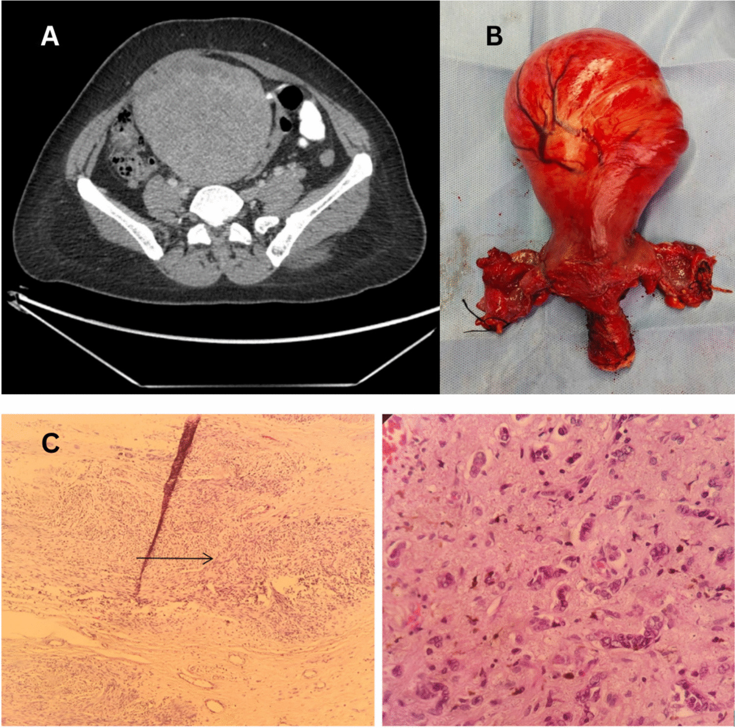 Neoplasm within Neoplasm—A Rare Case of Breast Carcinoma with Isolated Metastasis to a Uterine Leiomyoma