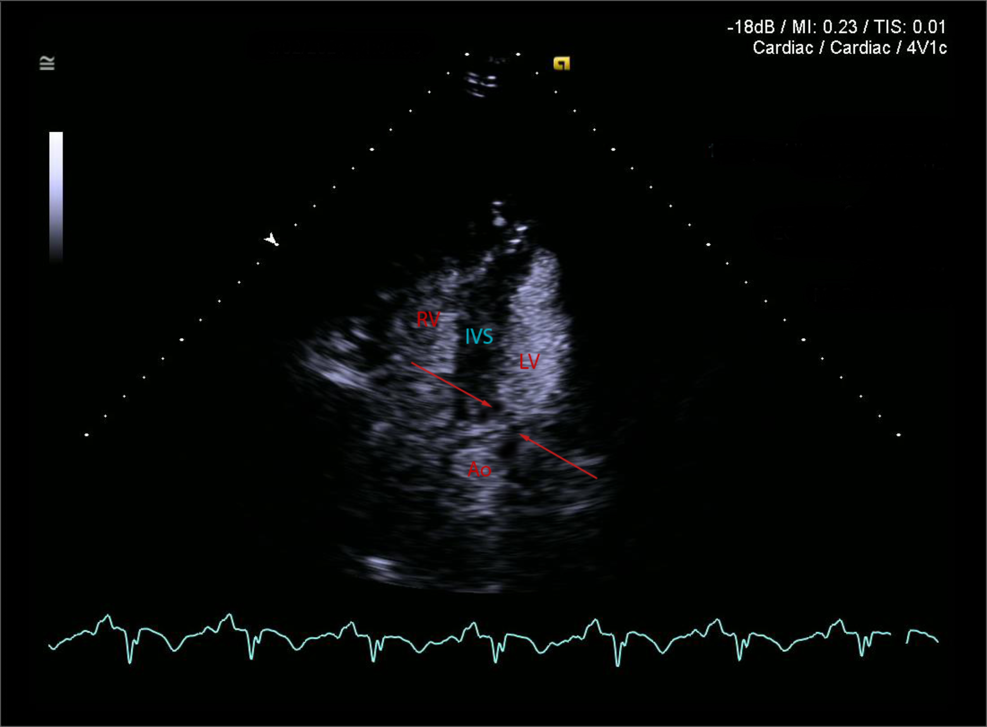 Dynamic left ventricular outflow tract obstruction induced by intra-aortic balloon pump in patient with angioedema