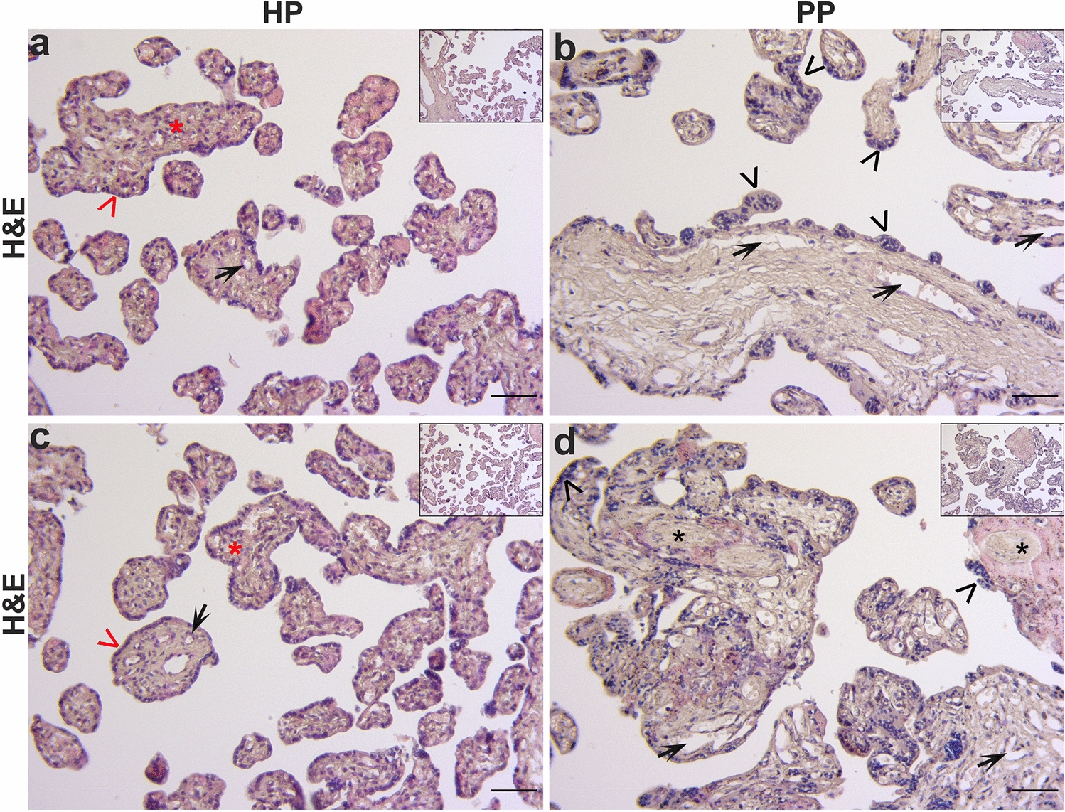 Distinct TYRO3 and PROS1 expression levels contribute to preeclampsia pathogenesis