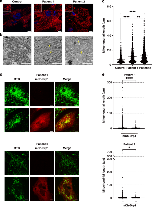 Cardiac dysfunction due to mitochondrial impairment assessed by human iPS cells caused by DNM1L mutations