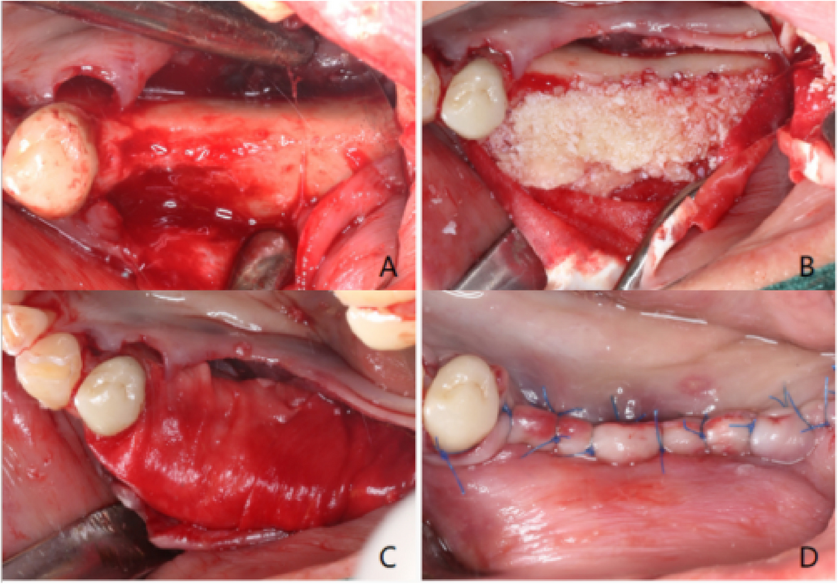 Stability of alveolar ridge following horizontal guided bone regeneration after implant loading for 1 -2 years: a retrospective comparative study