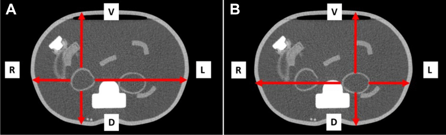 Development of a CT-less SPECT Acquisition Protocol for Kidney Dosimetry in Lu-PSMA-617 Radioligand Therapy
