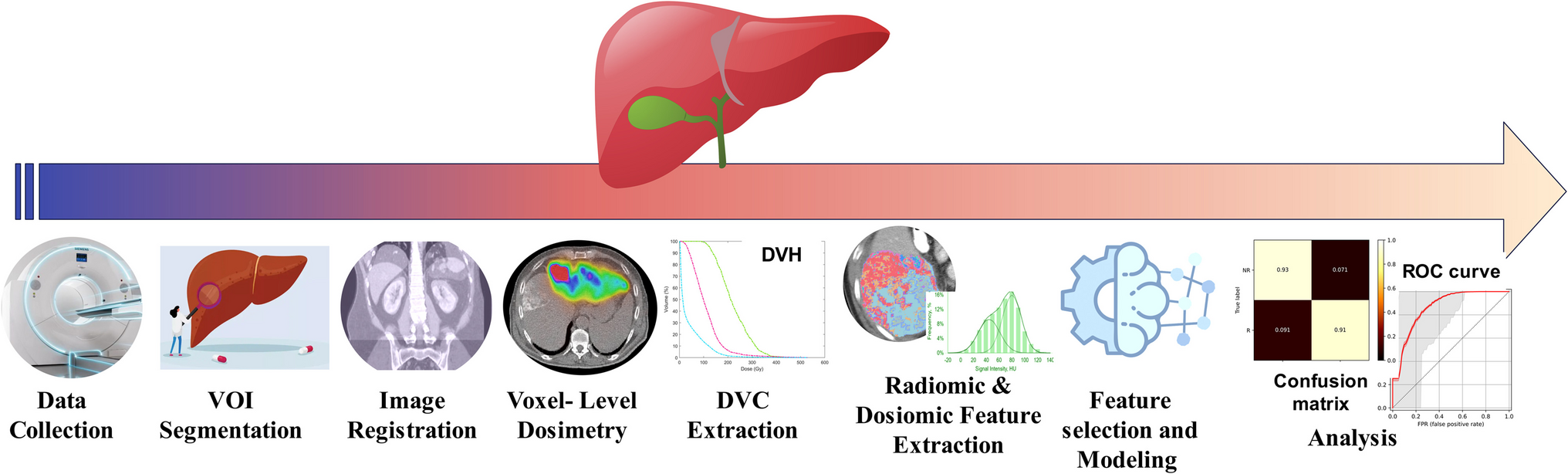 Potential of Radiomics, Dosiomics, and Dose Volume Histograms for Tumor Response Prediction in Hepatocellular Carcinoma following Y-SIRT