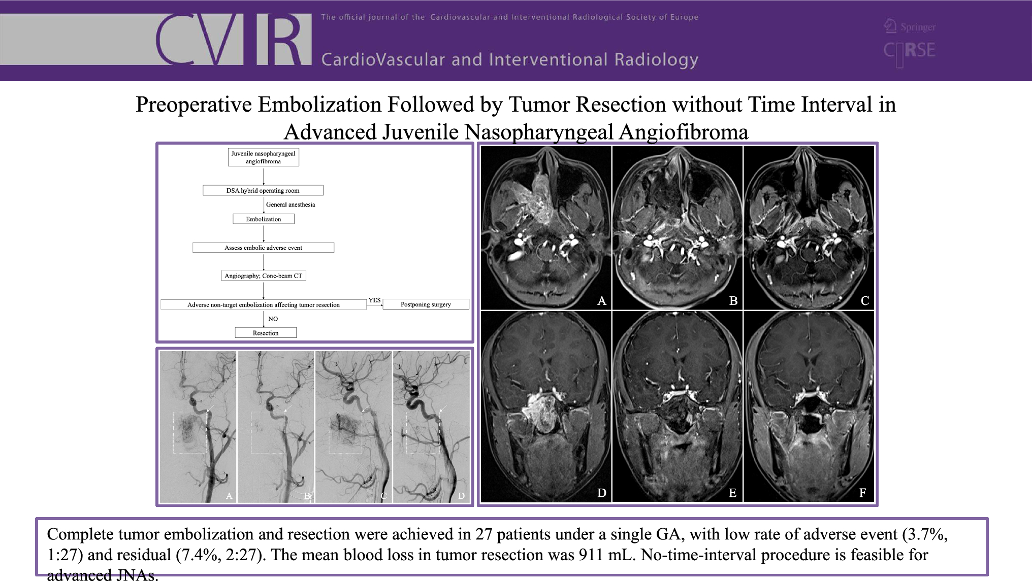Preoperative Embolization Followed by Tumor Resection Without Time Interval in Advanced Juvenile Nasopharyngeal Angiofibroma