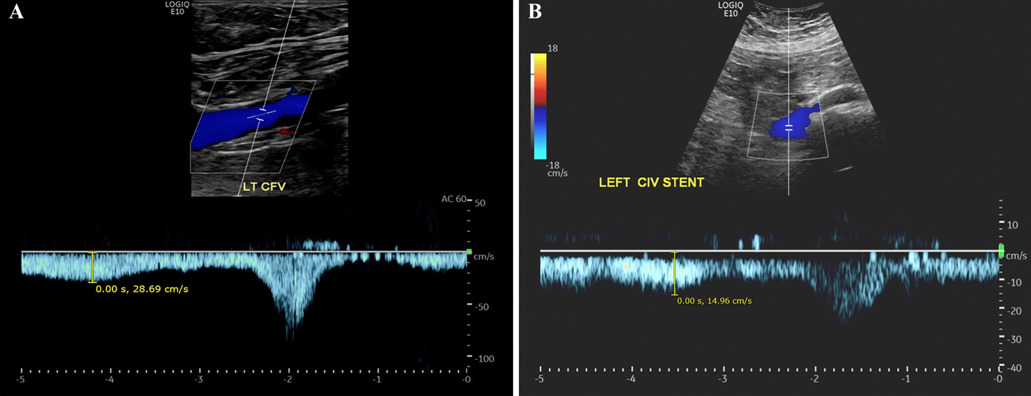 Low Post-Stent Placement Iliofemoral Vein Peak Velocity by Doppler Ultrasound: Prognostic Implication for Re-Intervention in Thrombotic Iliac Vein Lesions