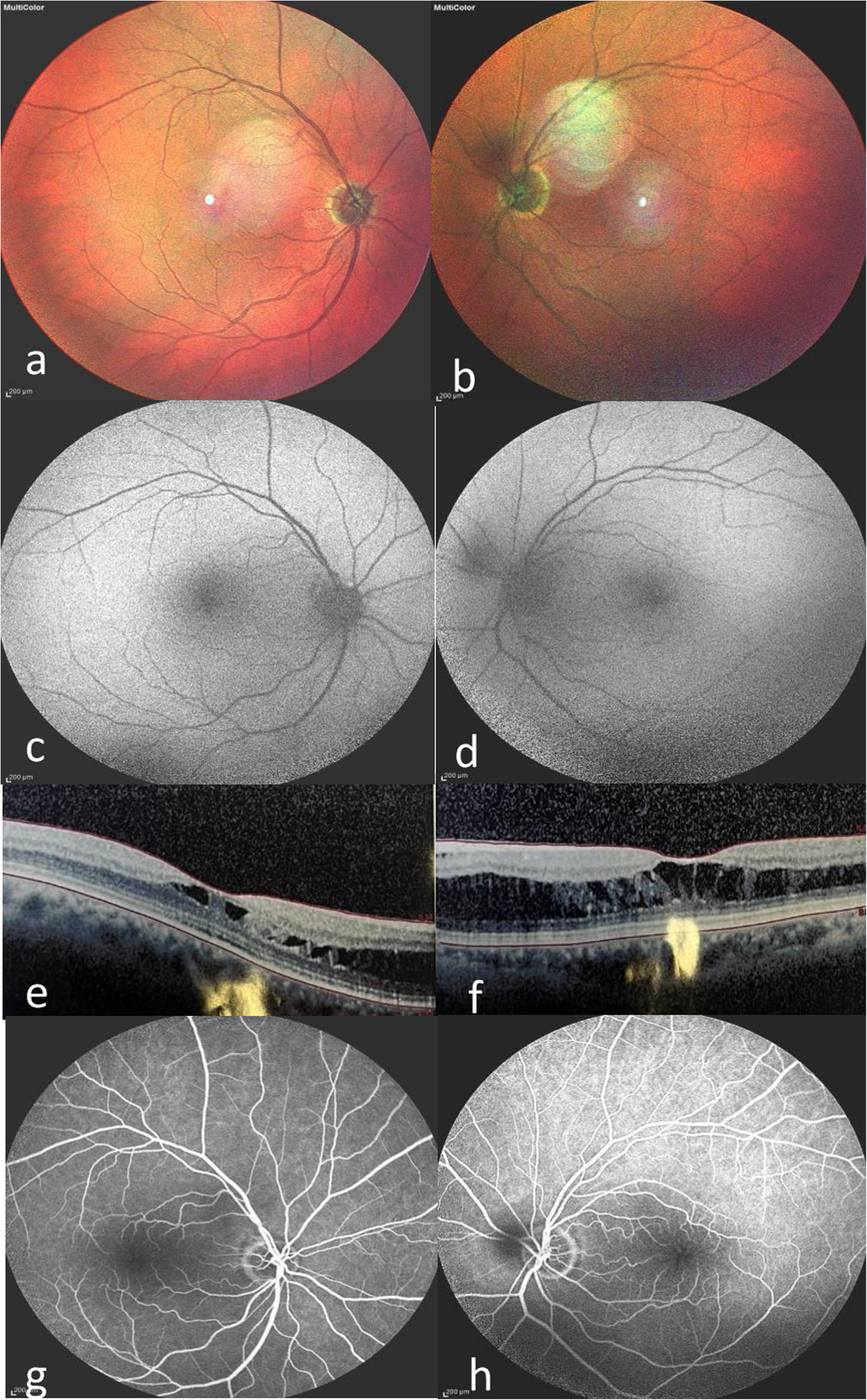 A case of bilateral stellate nonhereditary idiopathic foveomacular retinoschisis with 14-month follow-up: clinical features, OCT findings and treatment outcome