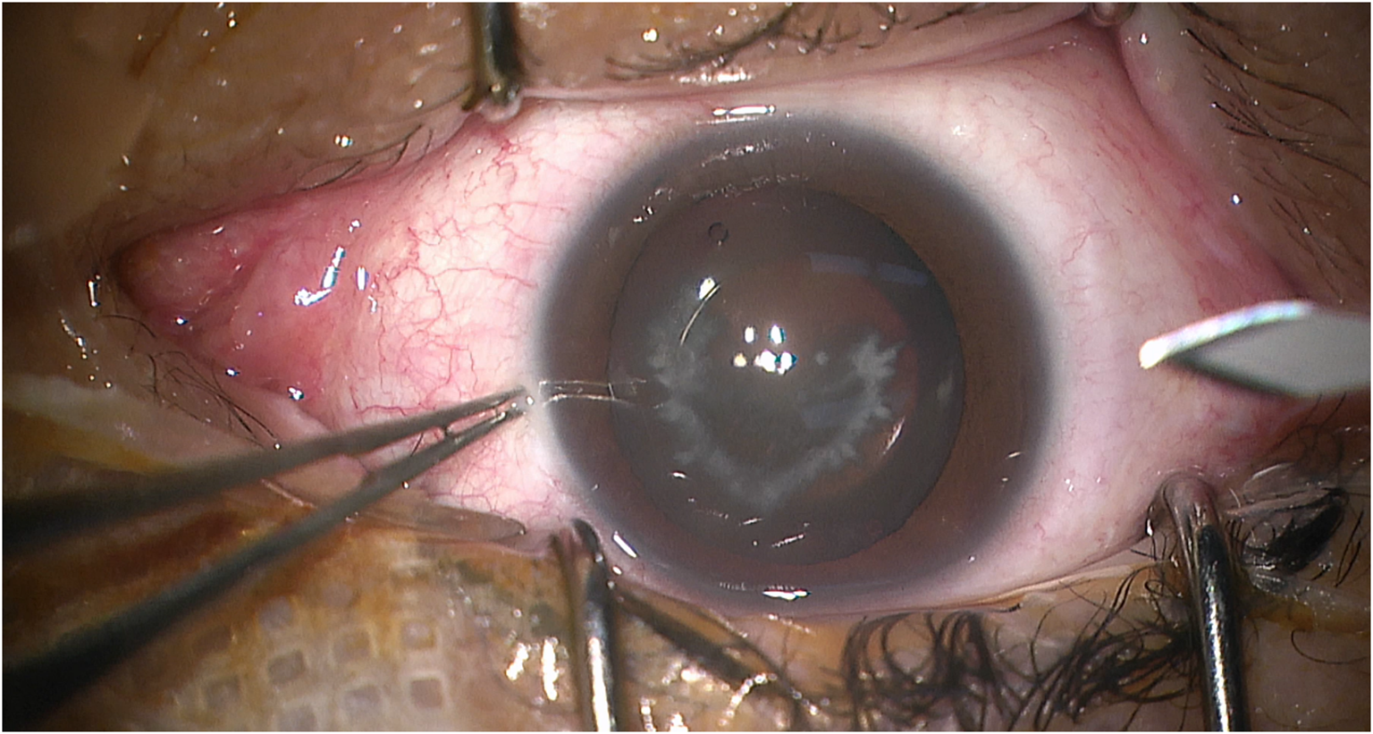 A case report of implantable collamer lens removal with cataract extraction and TECNIS Symfony extended range of vision intraocular lens (ZXR00) implantation