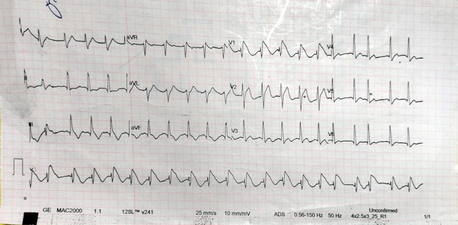 Aluminum phosphide poisoning with Brugada ECG: a case report highlighting diagnostic challenges arising from patient nondisclosure
