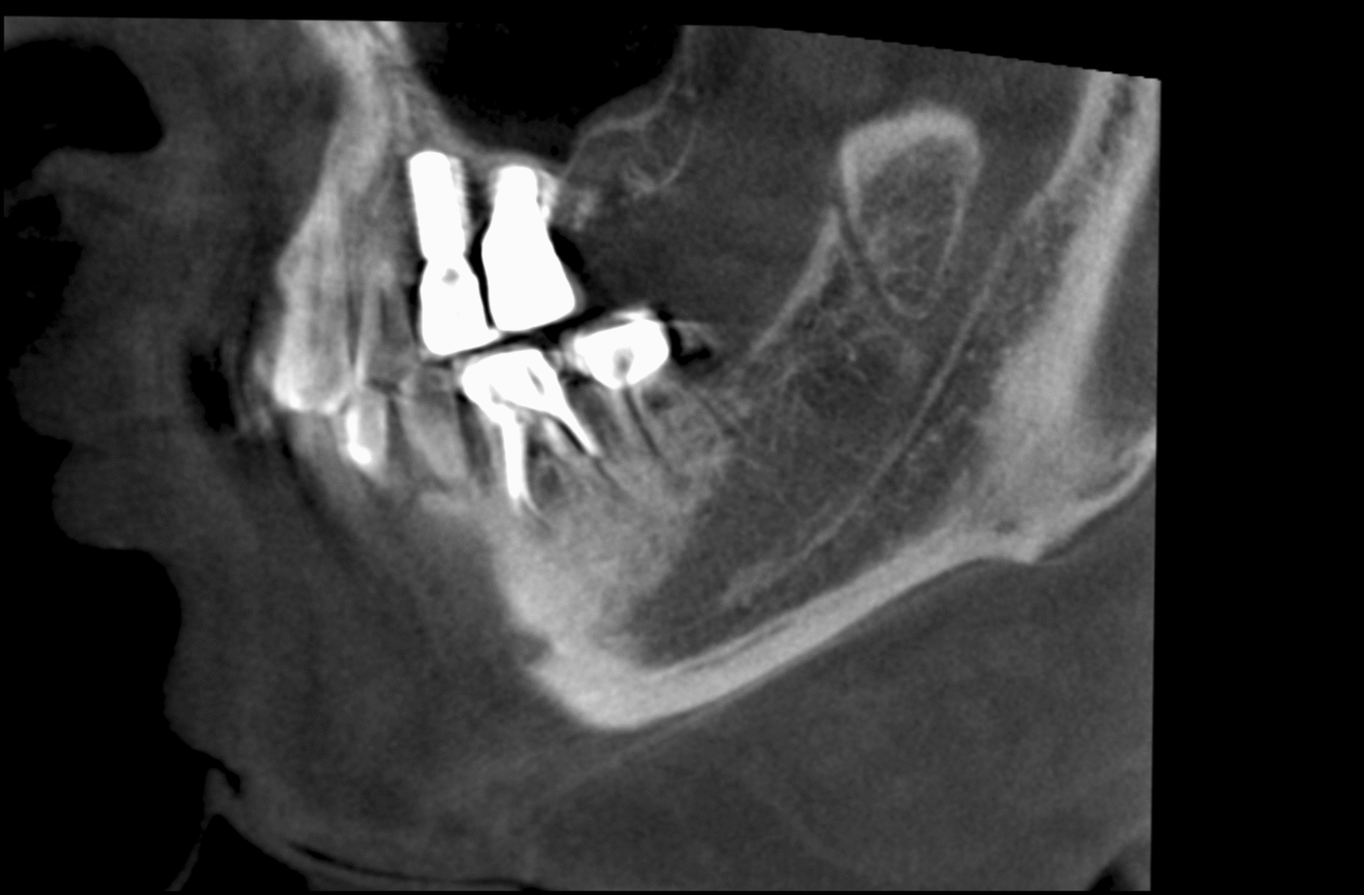 Evaluation of Bifid Mandibular Canals with Cone-Beam Computed Tomography in Saudi Population: A Retrospective Study