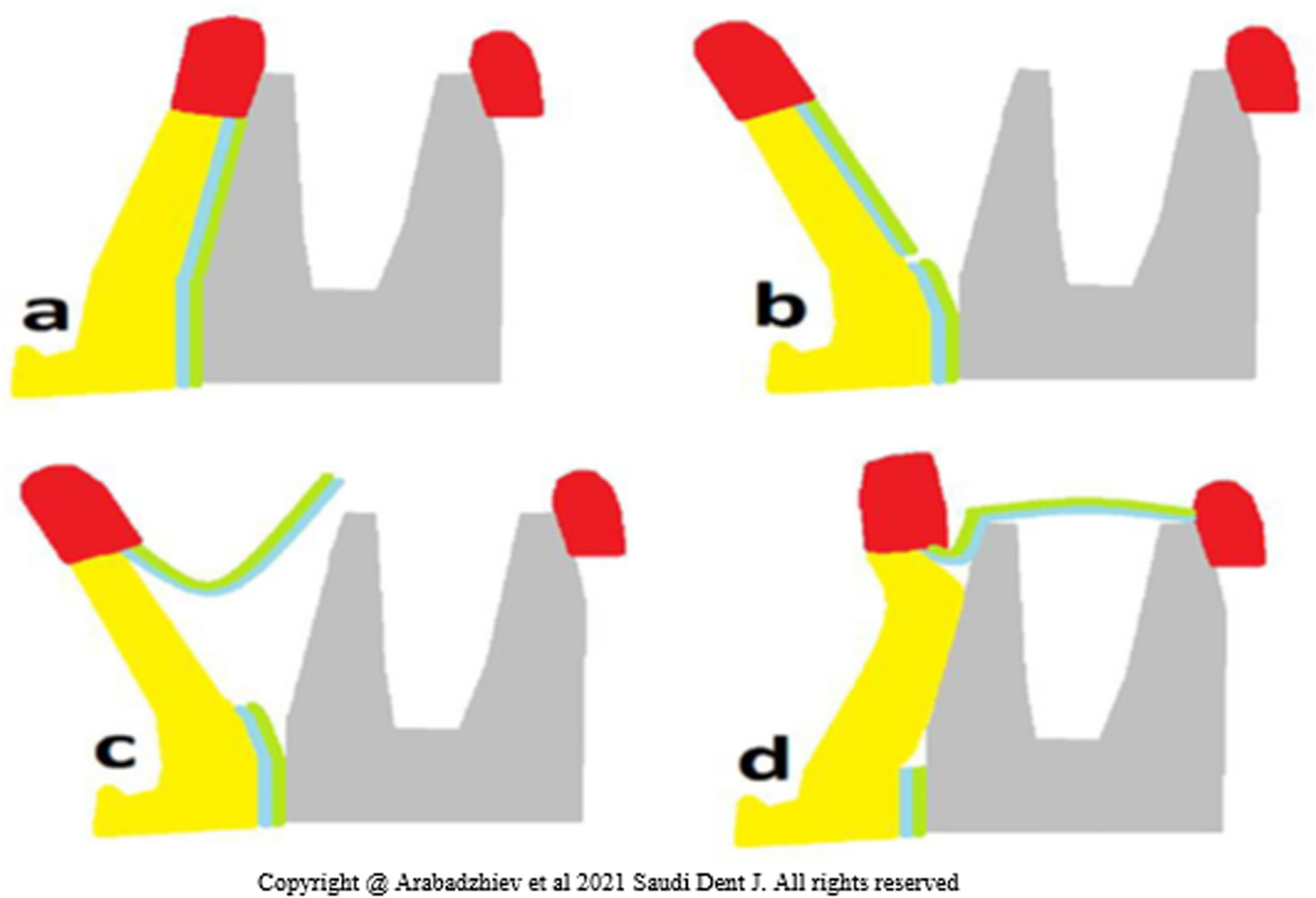 Buccal Periosteal Inversion Flap Technique After Tooth Extraction Versus Healing by Secondary Intention for Preservation of Keratinized Gingiva and Alveolar Ridge: A Comparative Study