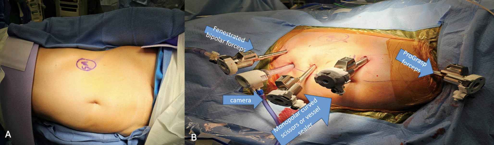 Robotic Assisted Laparoscopic Donor Nephrectomy: An Update