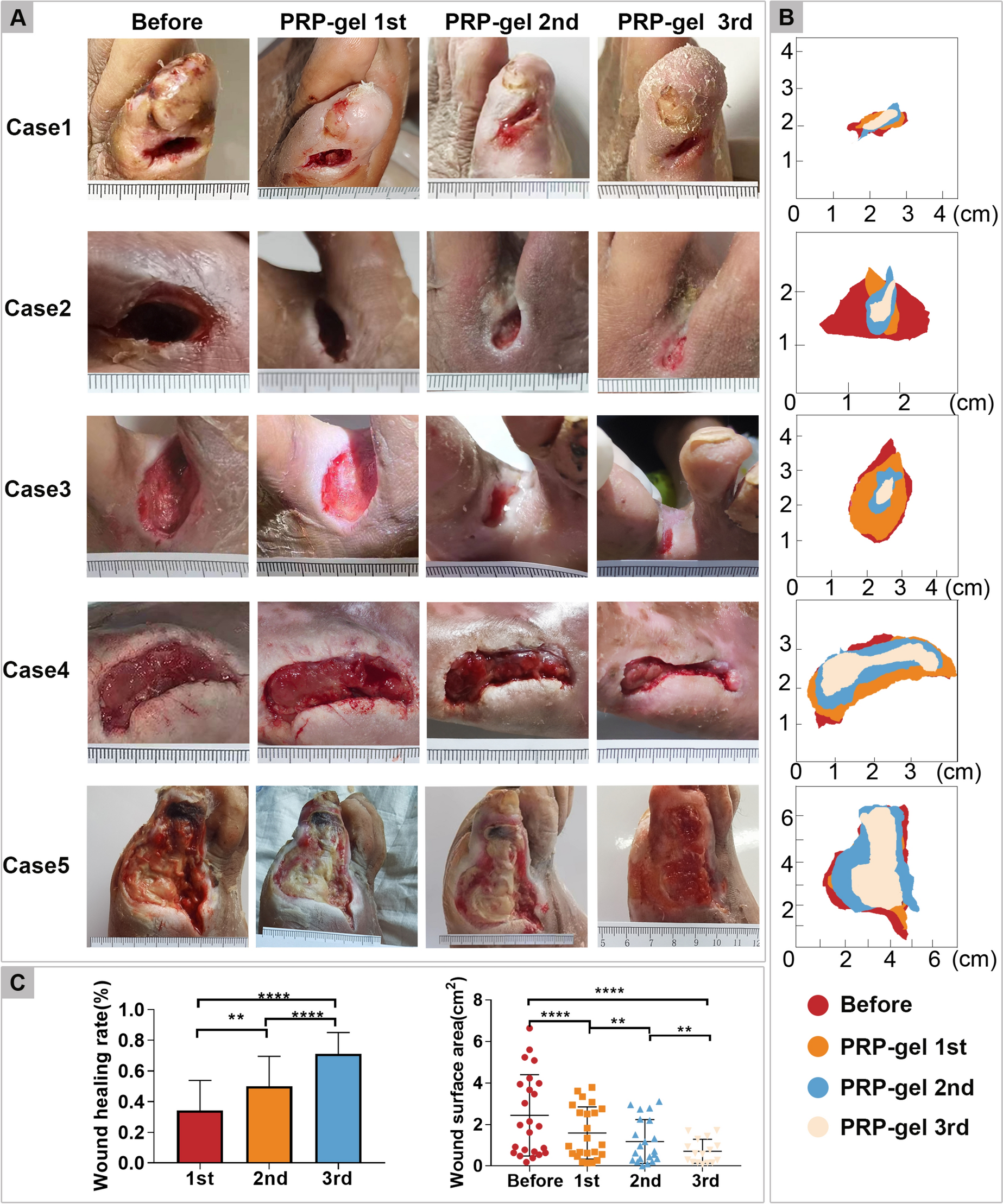 Platelet-rich plasma-derived exosomes accelerate the healing of diabetic foot ulcers by promoting macrophage polarization toward the M2 phenotype