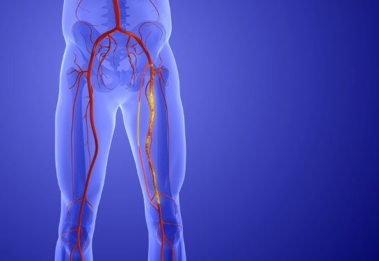 Vascular surgery provides patients with new minimally invasive treatment for peripheral artery disease