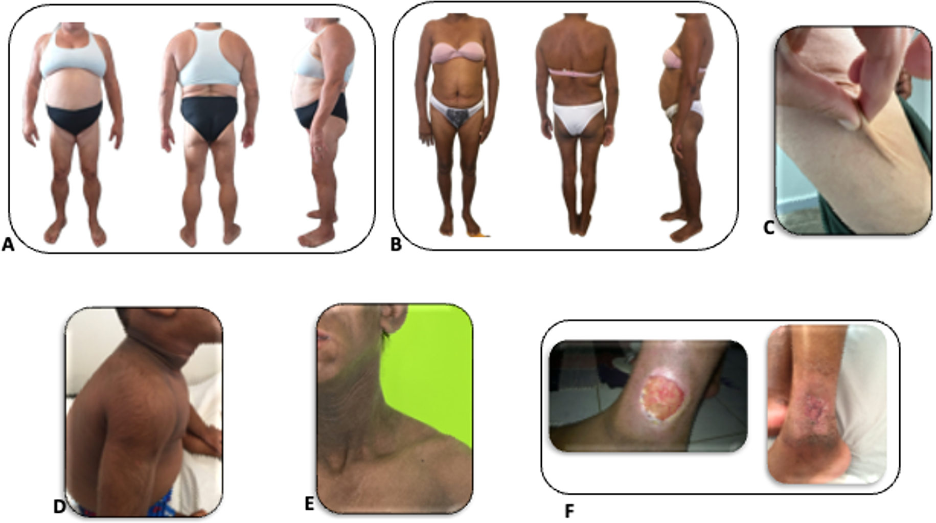 Diagnosis and Management of Genetic Lipodystrophy Syndromes and its Implications for Atherosclerosis