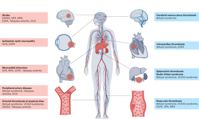 Arterial and venous thrombosis in systemic and monogenic vasculitis