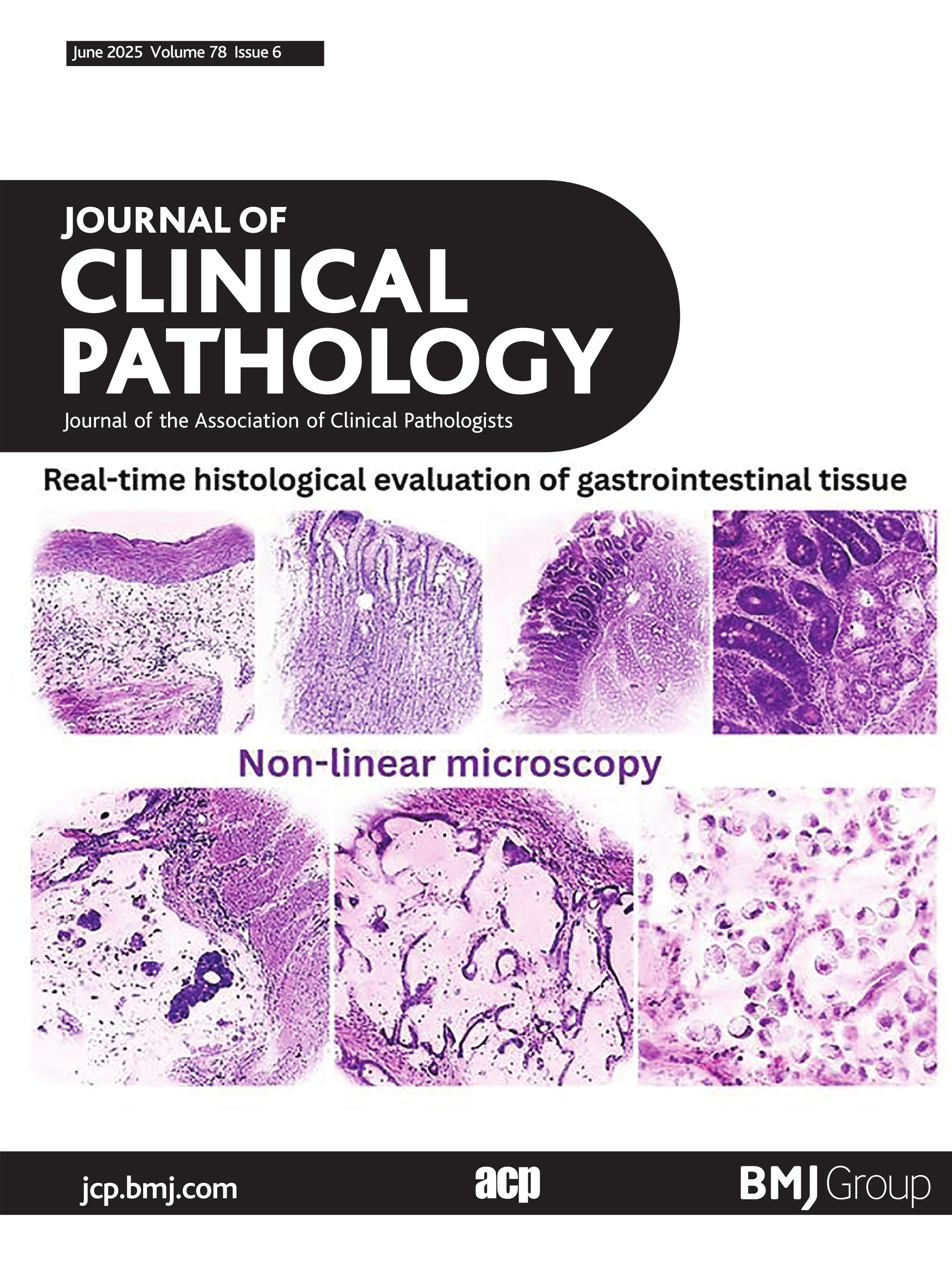 Unravelling switch/sucrose non-fermentable (SWI-SNF) complex-deficient thoracic tumours: a clinicopathological comparative on undifferentiated tumours and non-small cell lung carcinomas with BRG1 and BRM deficiency