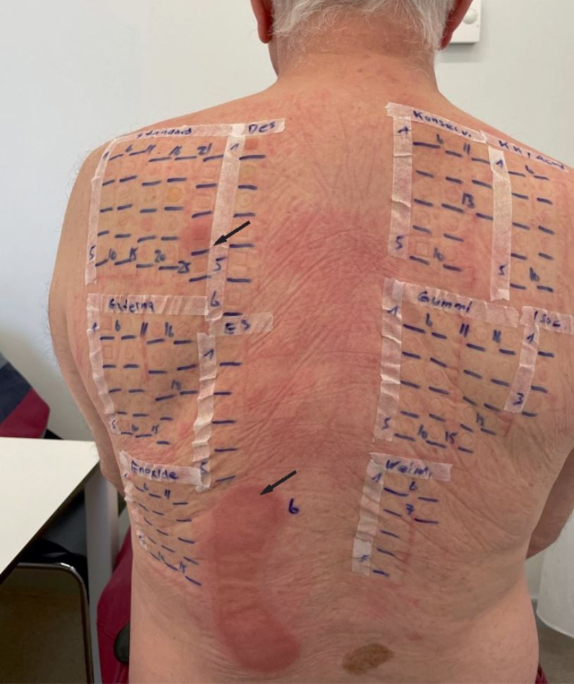 Die Dritte Niere: Fallbericht über eine außergewöhnliche Manifestation einer Kontaktdermatitis im Rahmen einer Allergie gegen Metyhlisothiazolinon