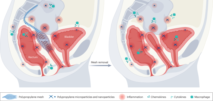 Effects of degradation-associated polypropylene particles in the surrounding tissue after surgical mesh implantation