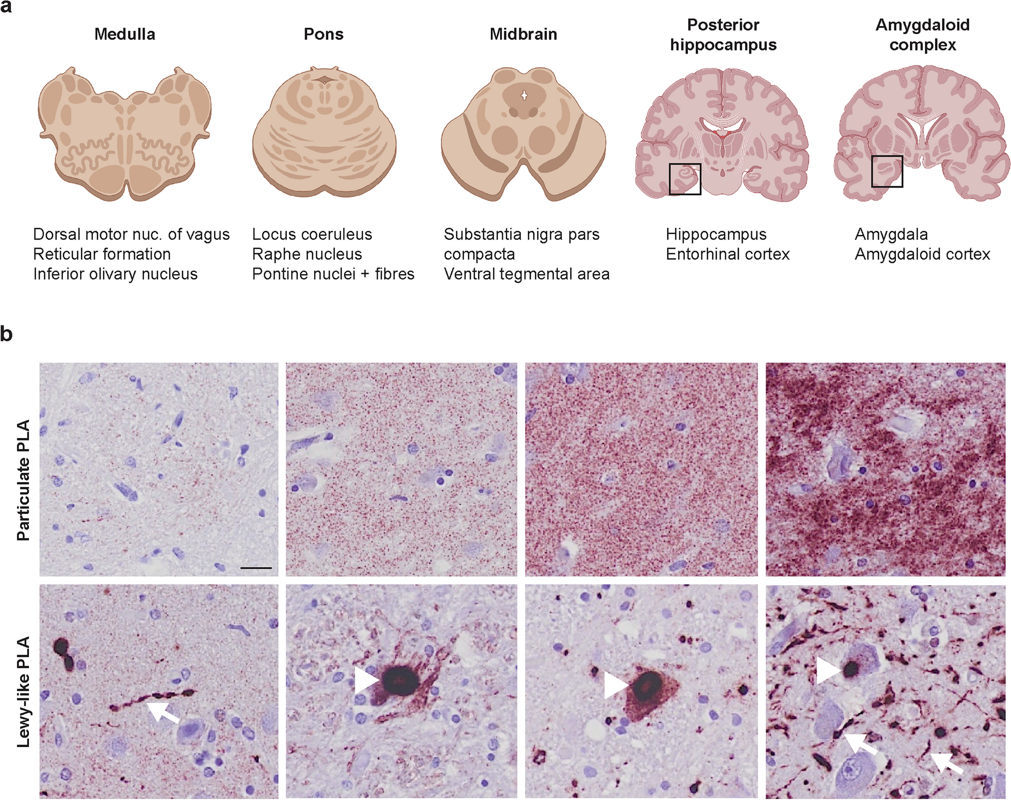 Abundant non-inclusion α-synuclein pathology in Lewy body-negative LRRK2-mutant cases