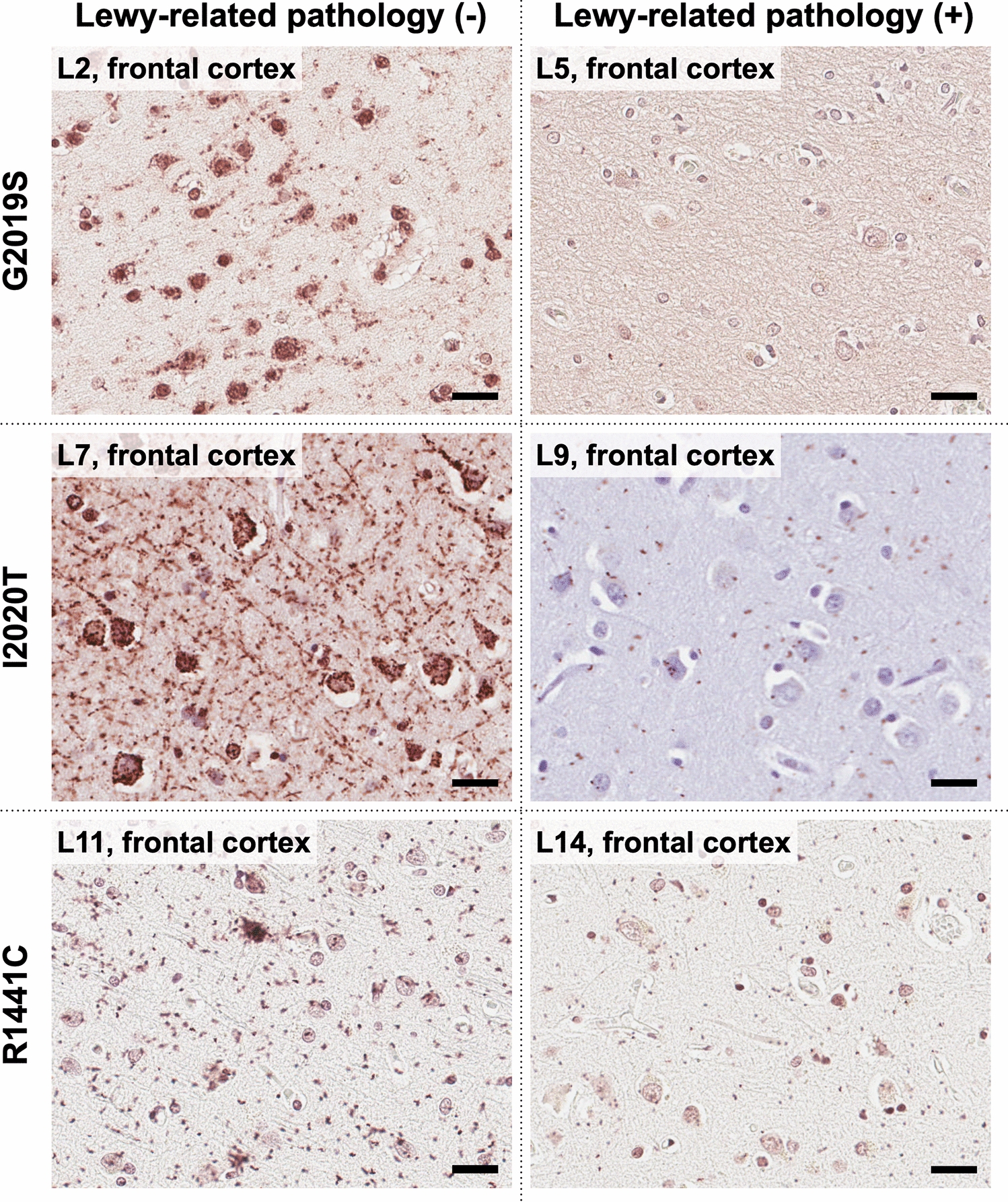 Widespread distribution of α-synuclein oligomers in -related Parkinson’s disease