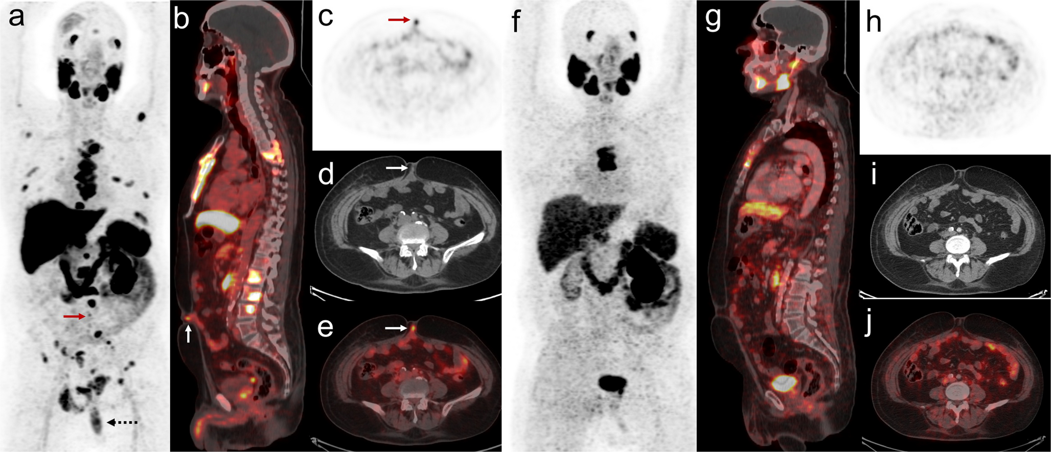 Rare Urachal Metastases in Prostate Cancer: A Case Highlighting the Utility of F-PSMA-1007 PET/CT