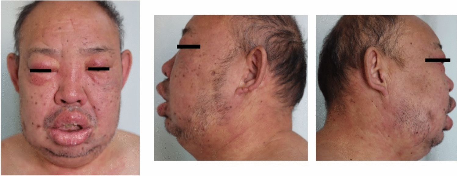 A case of angioimmunoblastic T-cell lymphoma mimicking angioedema