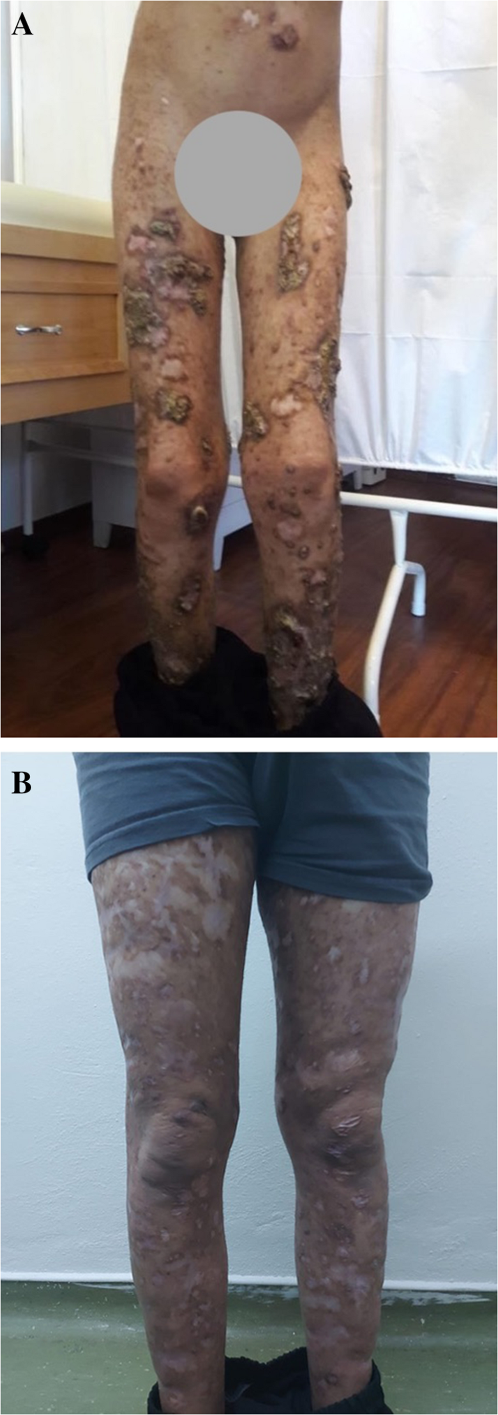 Successful Treatment of Skin Dyskeratosis Due To NLRP1 Mutation Using Baricitinib