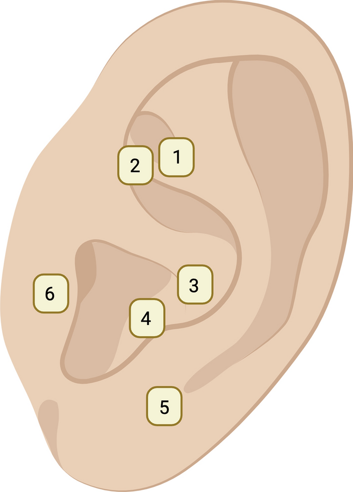 Potential of Auriculotherapy in Pain, Edema and Anxiety Management Following Orthognathic Surgery: A Multicenter, Randomized, Placebo-Controlled and Triple-Blind Study