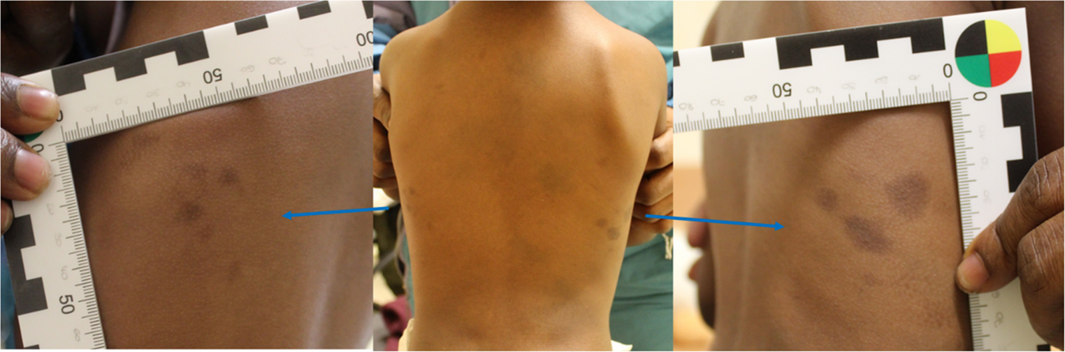 Forensic evaluation of atypical Mongolian spots in dark pigmented skin: navigating the differential diagnosis of potential child abuse