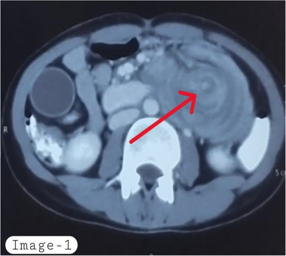 Case Report of Duodeno-Pancreaticojejunal Intussusception in a Patient with Tubulovillous Adenoma of Duodenum Who Presented with Intermittent Obstruction and Jaundice