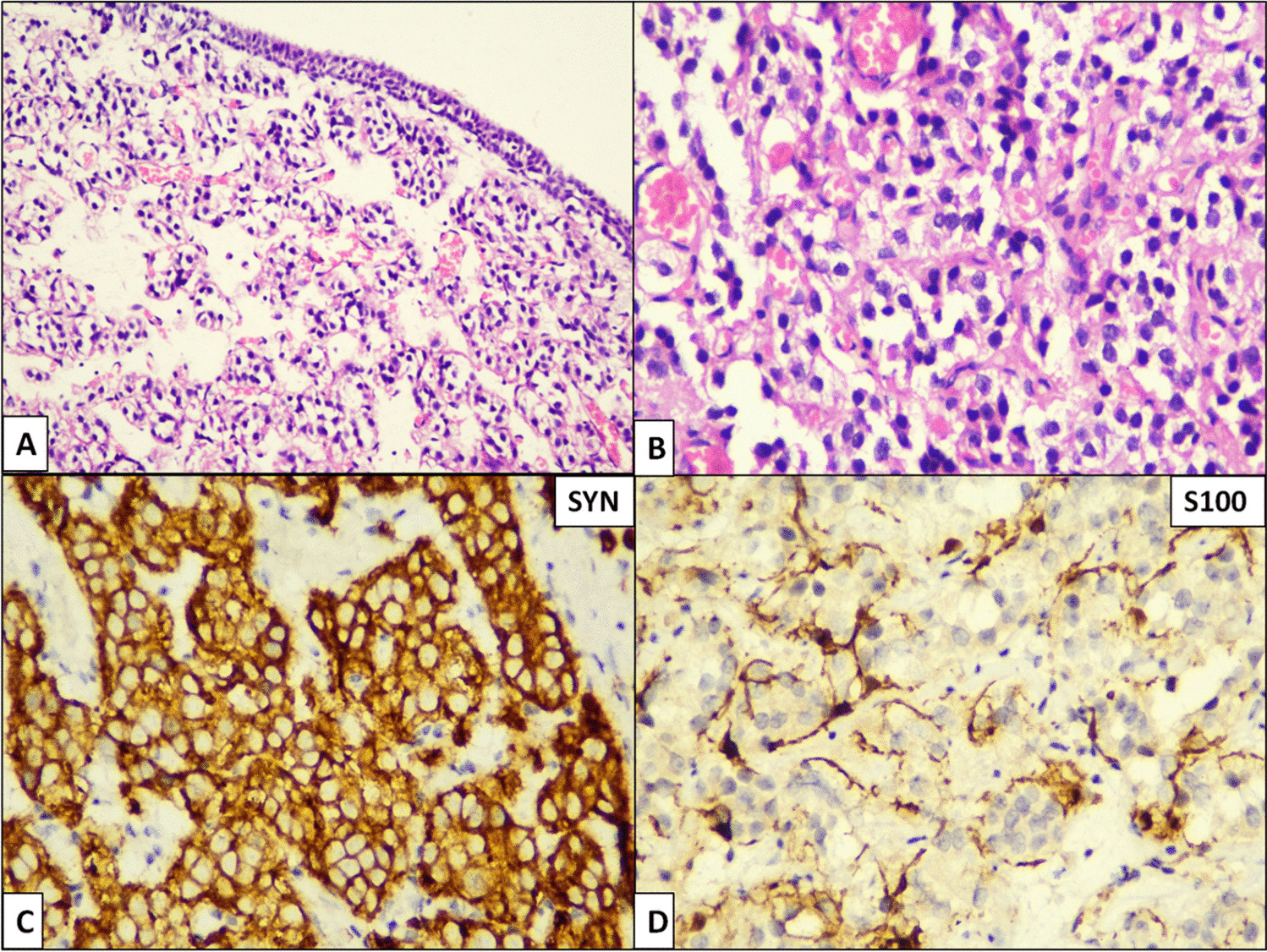 Extraadrenal Paraganglioma Involving Prostatic Urethra – a Rare Site Occurrence