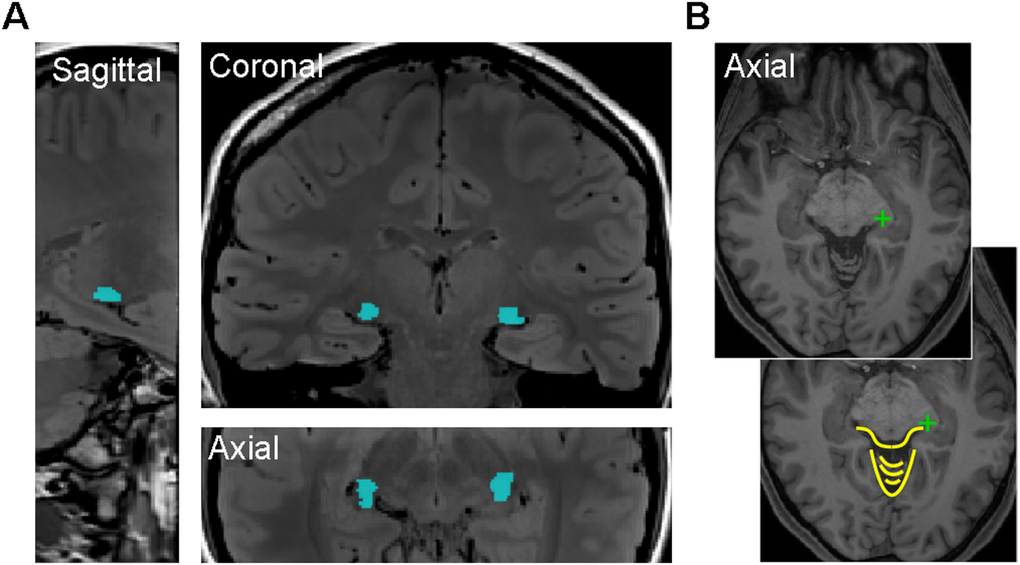 Evaluating the effective segmentation of human lateral geniculate nucleus