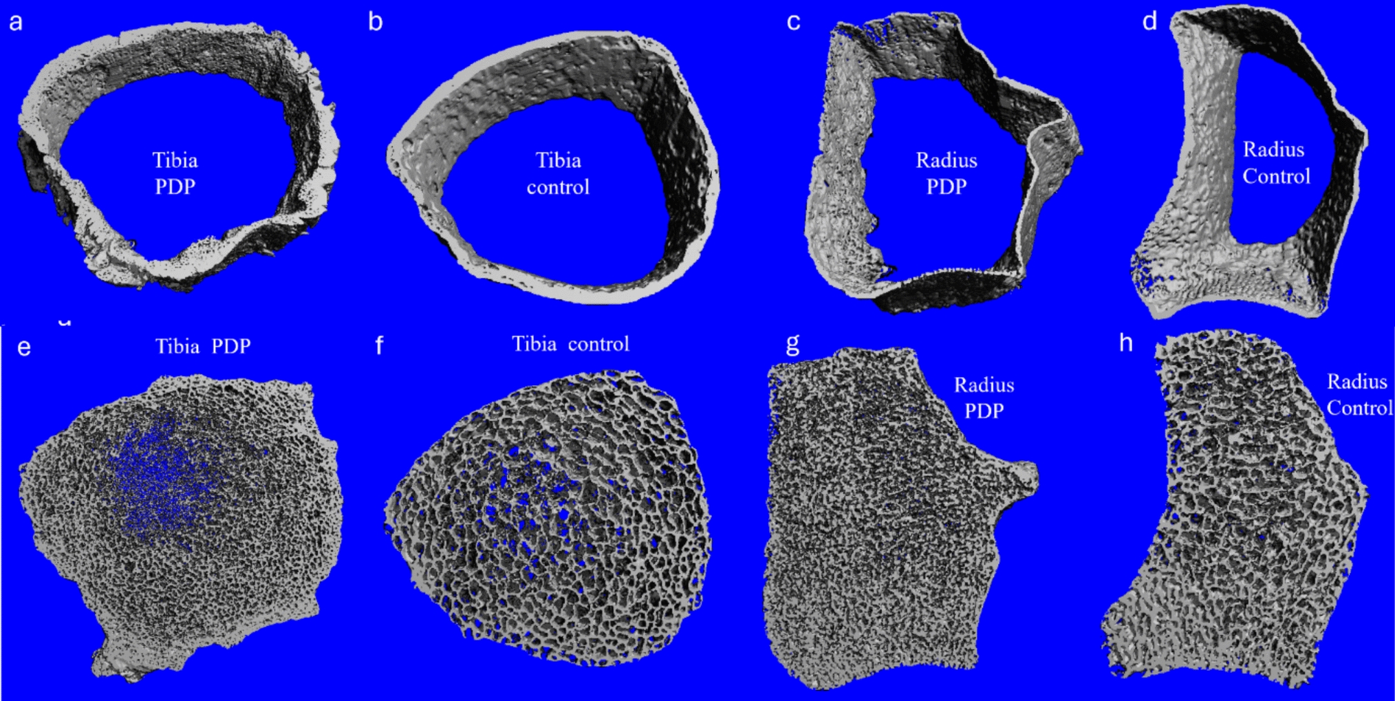 Bone Density, Microarchitecture, and Geometry Assessment in Patients with Pachydermoperiostosis Using Second-Generation High-Resolution Peripheral Quantitative Computed Tomography: A Case–Control Study