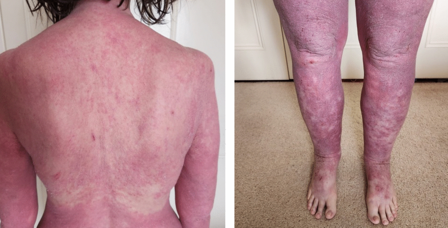 Early Postmenopausal Fragility Fractures and Elevated IgE: Two Cases Suggesting Hyper-IgE Syndrome and a Novel Adverse Reaction to Romosozumab