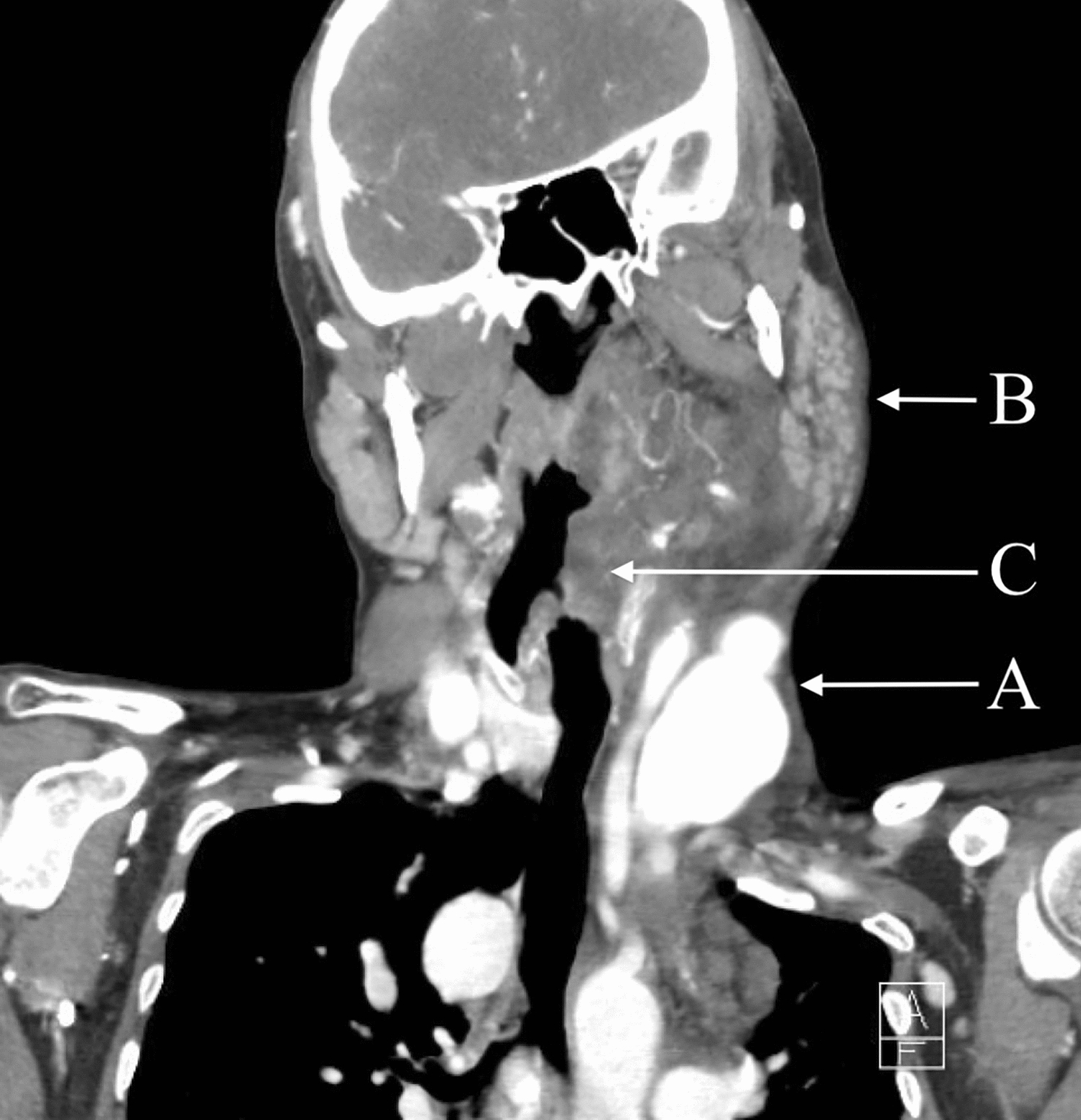 Anticipated difficult airway management and multidisciplinary approach to a patient with a high-risk pregnancy