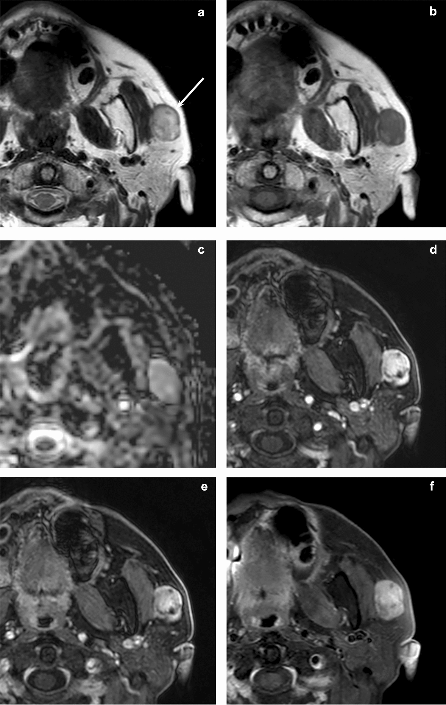 MRI and CT features of head and neck myoepithelioma: comparison with parotid pleomorphic adenoma
