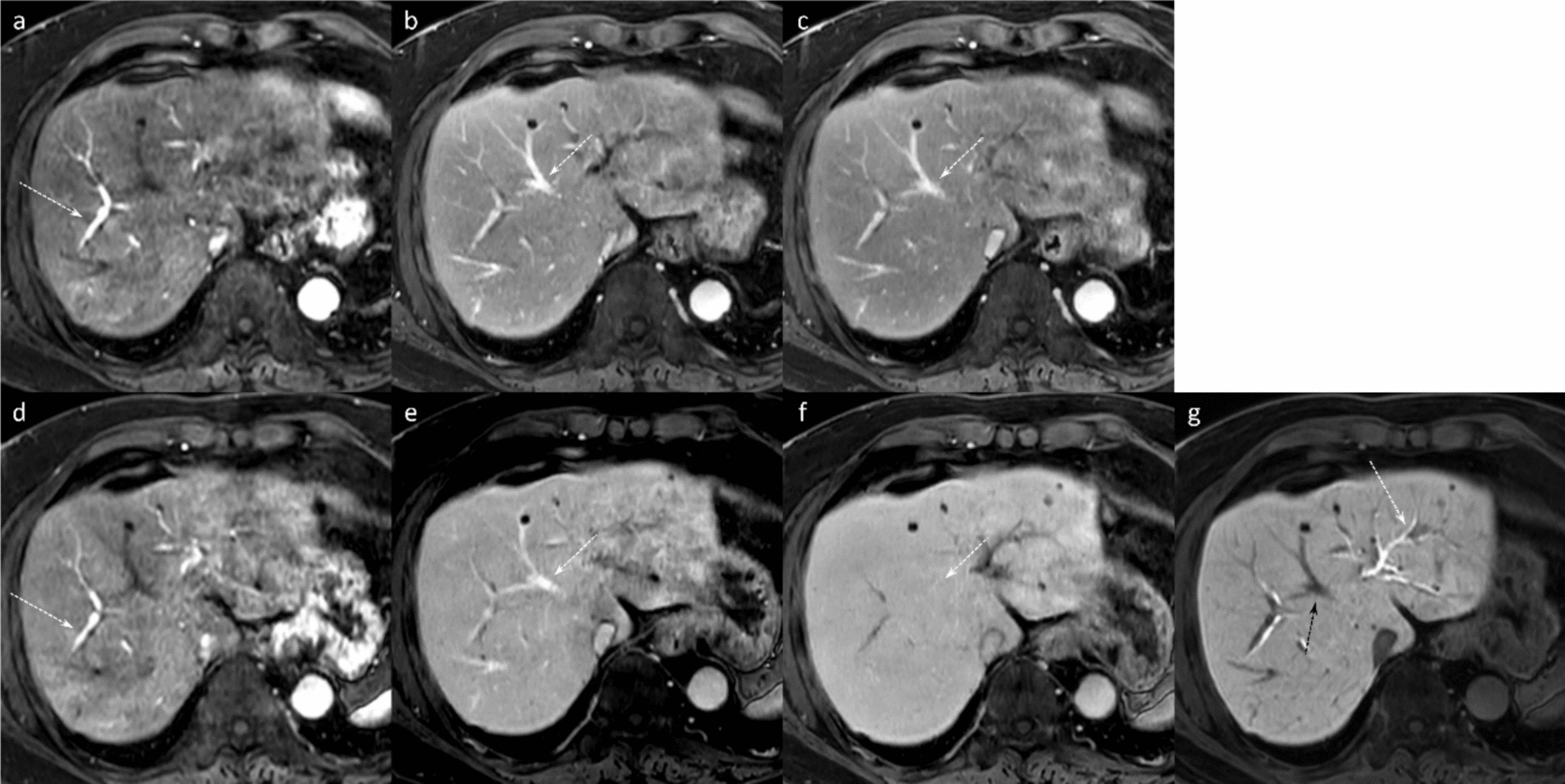 Gadoxetic acid-enhanced MRI in hepatocellular carcinoma: a comprehensive review of diagnostic, surveillance, and treatment response prediction and assessment