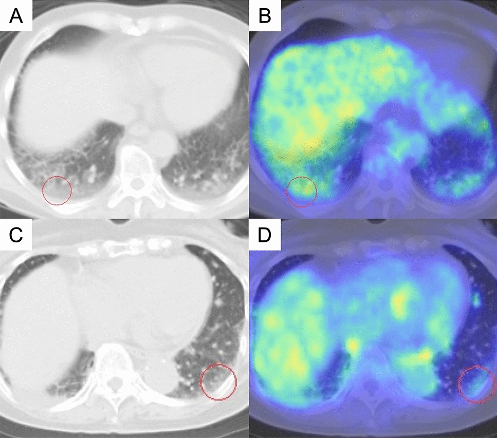 Association between FDG accumulation in interstitial lesions and acute exacerbation risk in lung cancer: multicenter analysis