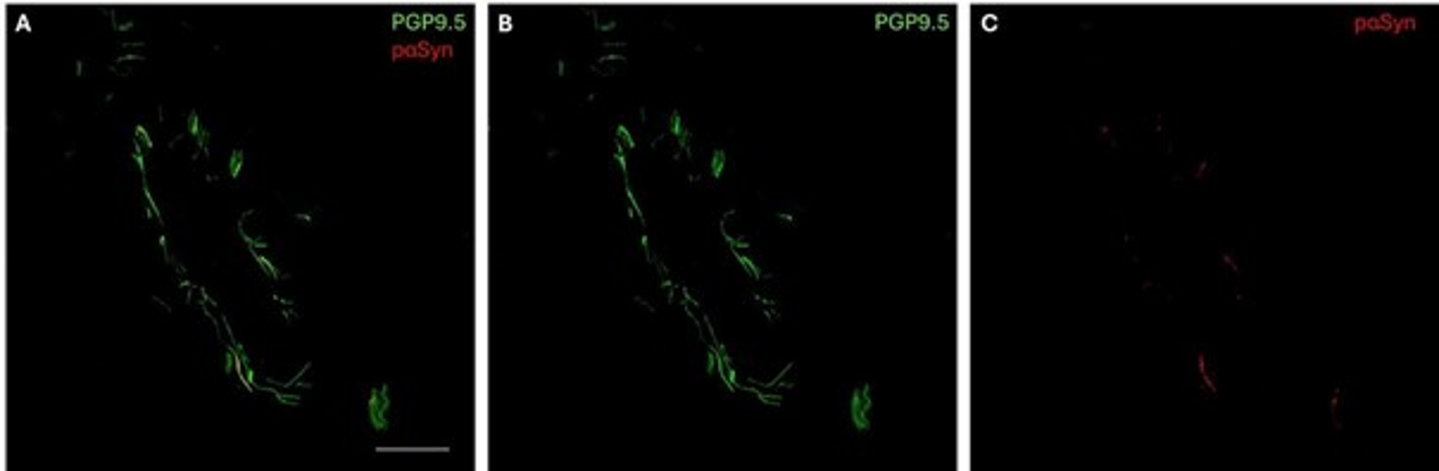 In-vivo evidence of synucleinopathy in parkinsonism due to VCP mutation