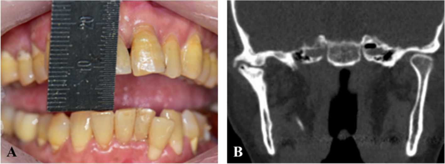 The capsular vein as a novel surgical landmark for safe access to the temporomandibular joint: a retrospective cohort study