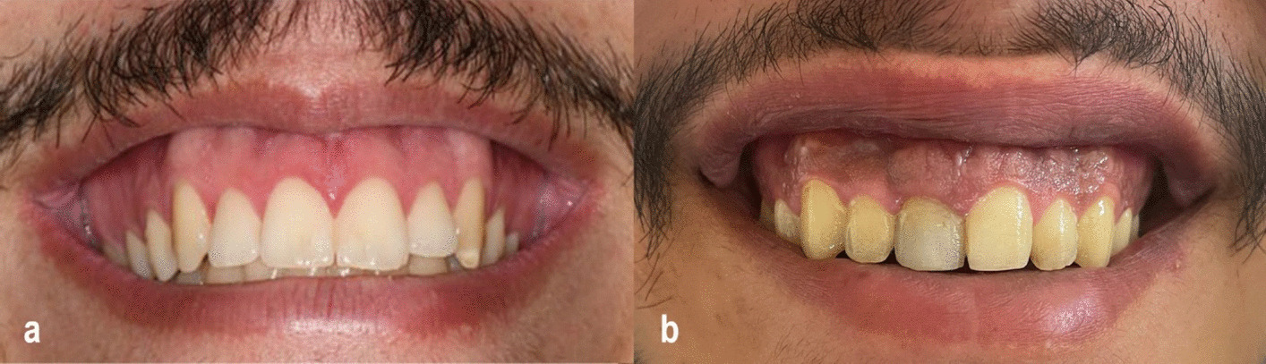 Comparison between the surgical scalpel and carbon dioxide laser in managing excessive gingival display using lip repositioning technique: a randomized controlled clinical study