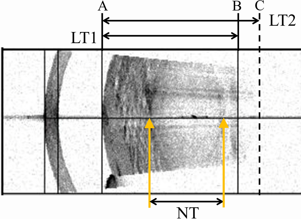 Detection of a white cataract with elevated intralenticular pressure using an optical biometer based on swept-source optical coherence tomography