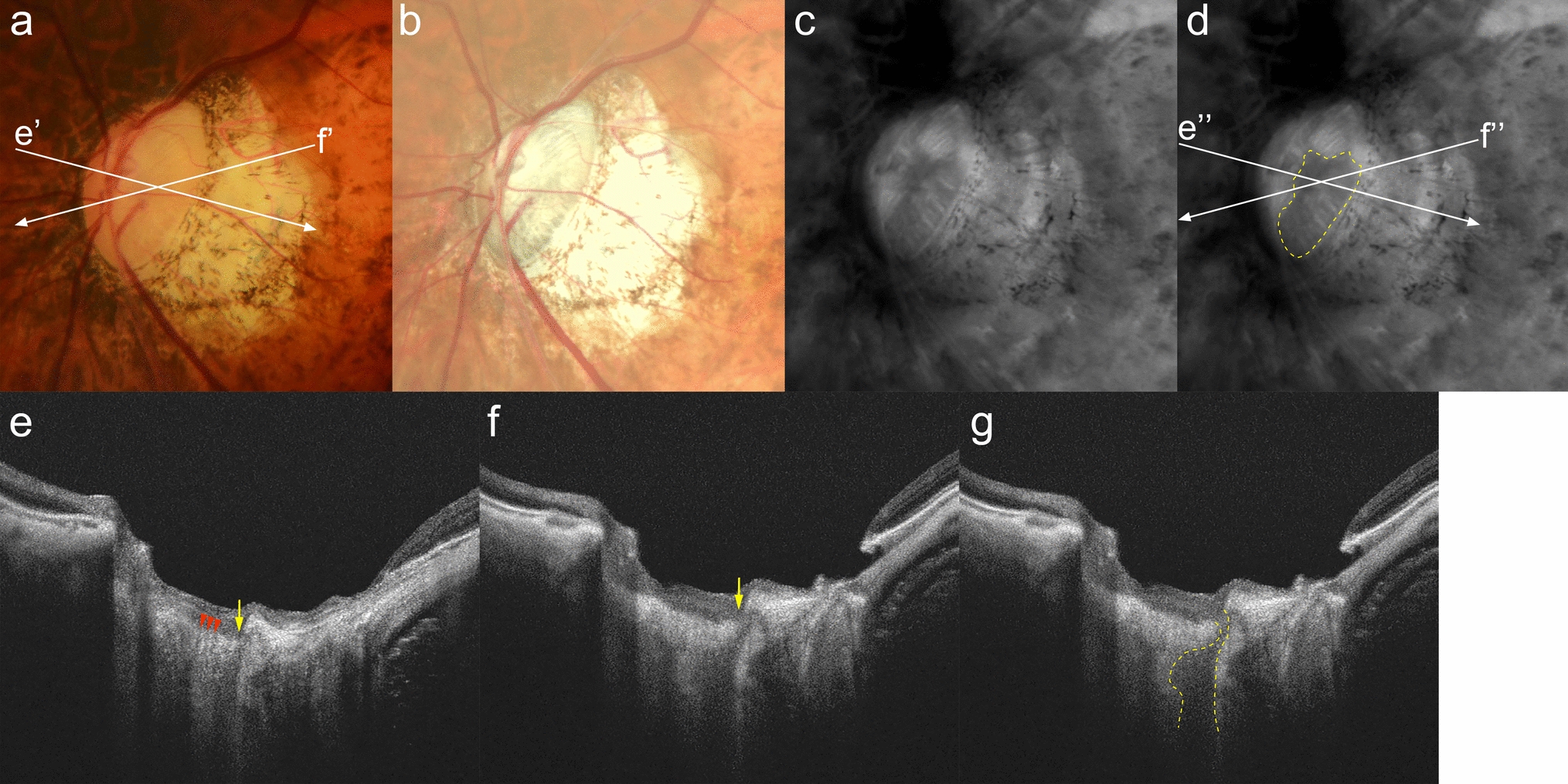 Detection of optic disc abnormalities using retro-mode scanning laser ophthalmoscopy