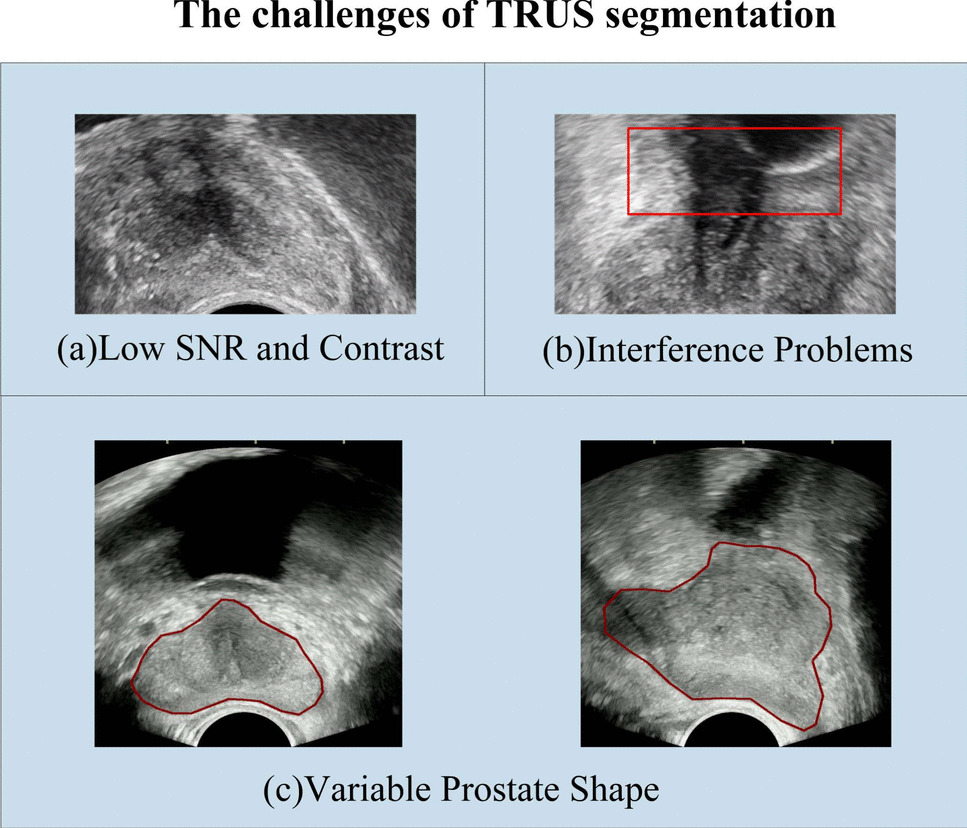 TCF-Net: A Hierarchical Transformer Convolution Fusion Network for Prostate Cancer Segmentation in Transrectal Ultrasound Images