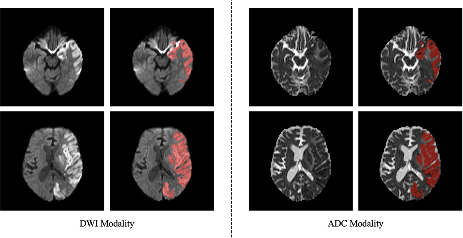 Exploiting Cross-modal Collaboration and Discrepancy for Semi-supervised Ischemic Stroke Lesion Segmentation from Multi-sequence MRI Images