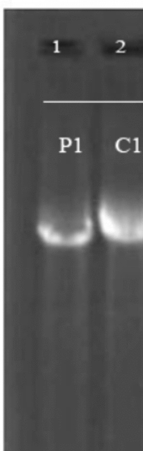 Application of capillary gel electrophoresis in detection of Factor VIII gene intron 22 inversion of hemophilia A