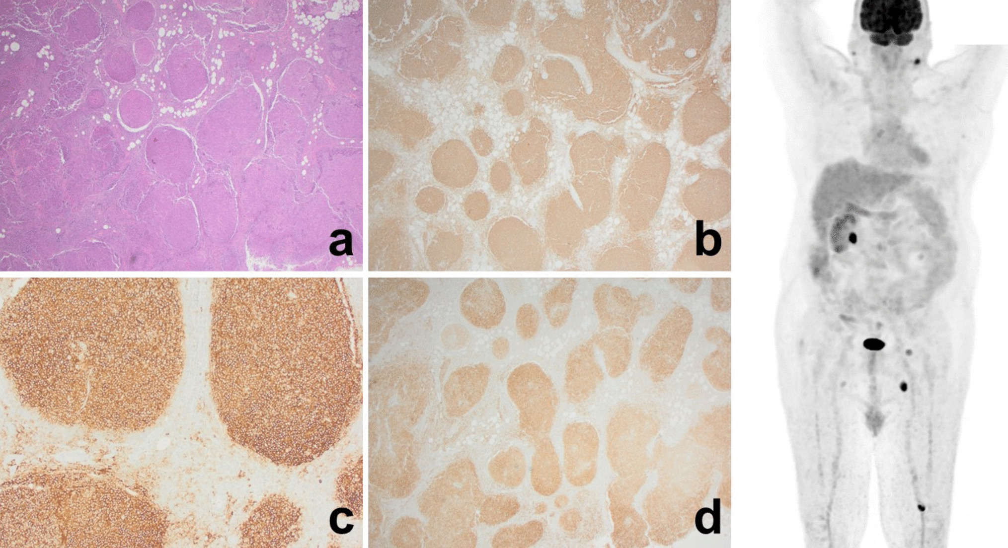 A rare case of Hodgkin lymphoma transformed from follicular lymphoma demonstrating 14;18 translocation