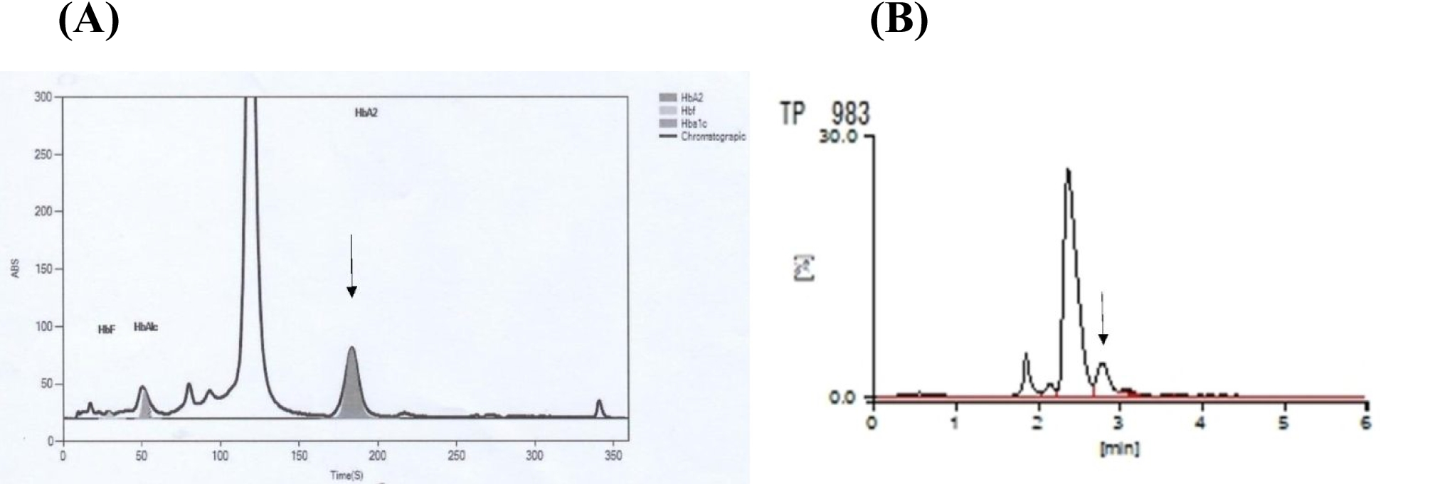 A rare alpha globin chain variant hemoglobin Fontainebleau poses diagnostic challenges by yielding different results in two different HPLC systems