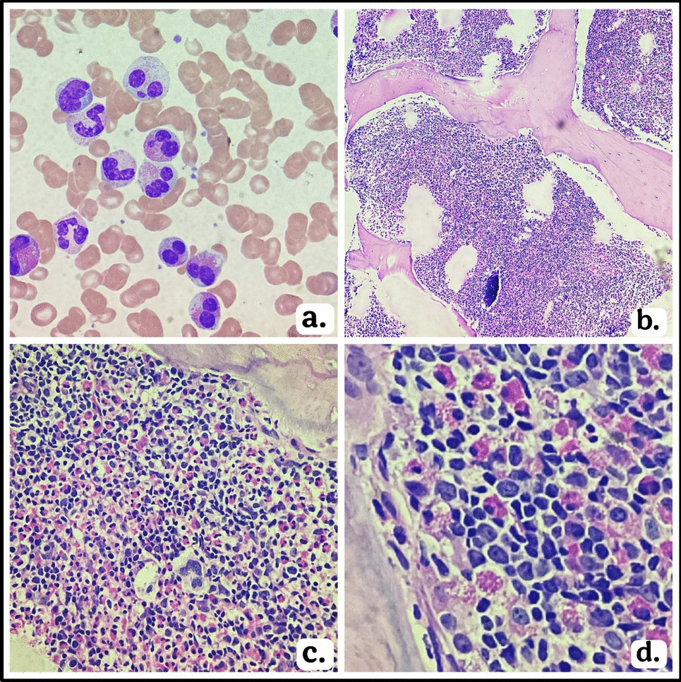 Masked by eosinophils: a cryptic presentation of pediatric B-ALL with IGH rearrangement